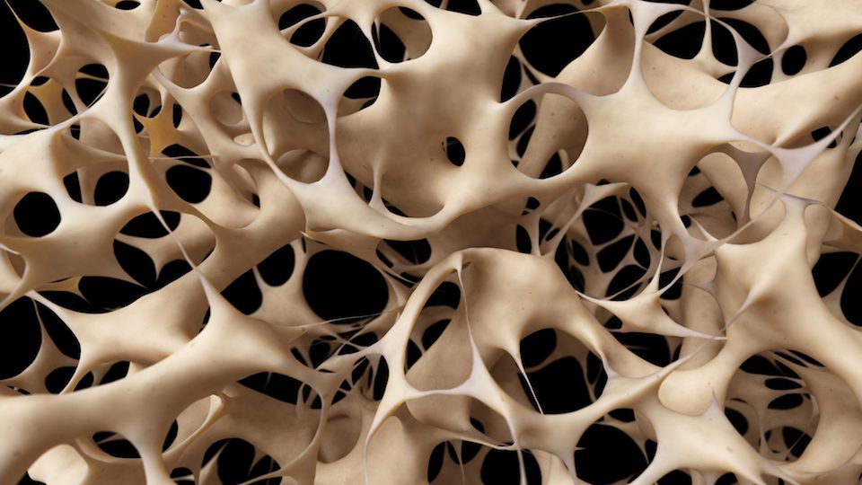 Osteoperosis
